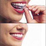 Invisalign in Patchoque, Coram, Sony Brook and Mt Sinai NY